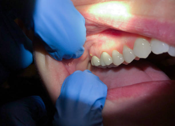Best Knocked-Out Tooth (Avulsed Tooth) Treatment in Park City, KS